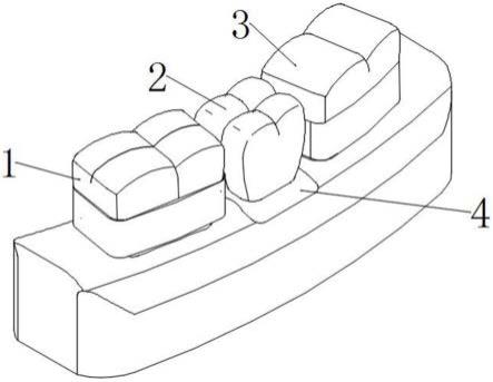 3D激光金属打印固定义齿的制作方法