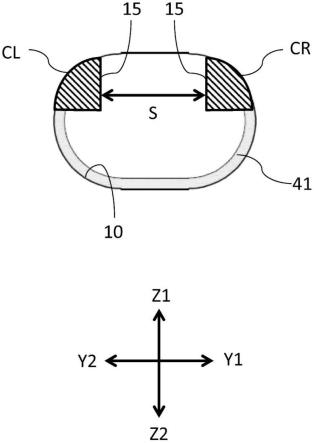 眼内透镜插入器具及其设计方法与流程