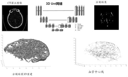 脑梗塞核心区变化的血管形态学指标的提取与筛选方法与流程