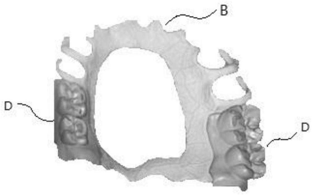 一种数字化可摘局部义齿的制作方法与流程