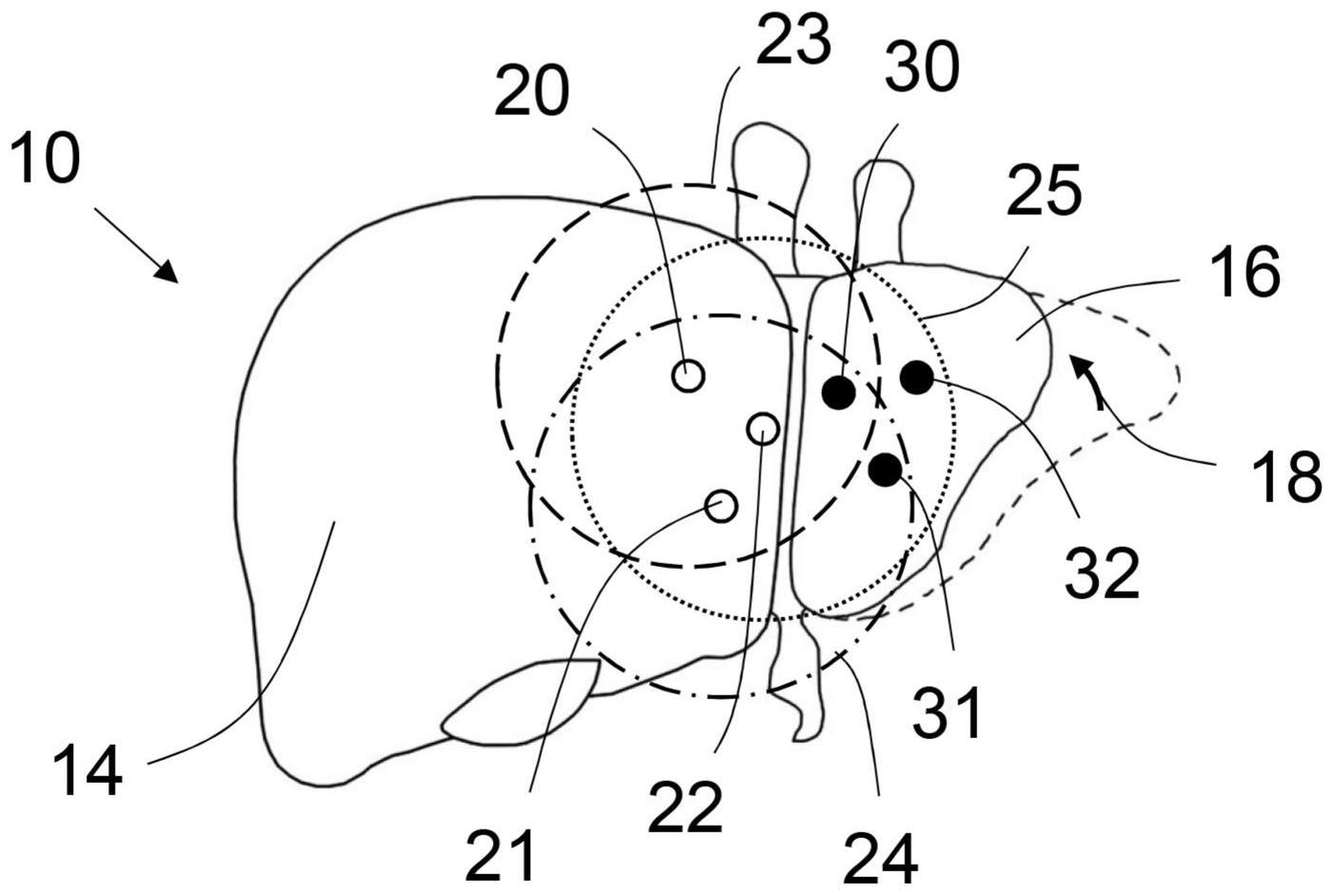 医学成像系统及其操作方法、模拟器官的三维模型的局部变形的方法与流程