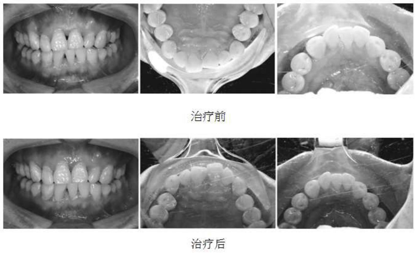 一种治疗慢性牙周炎的药物组合物及制备方法和用途