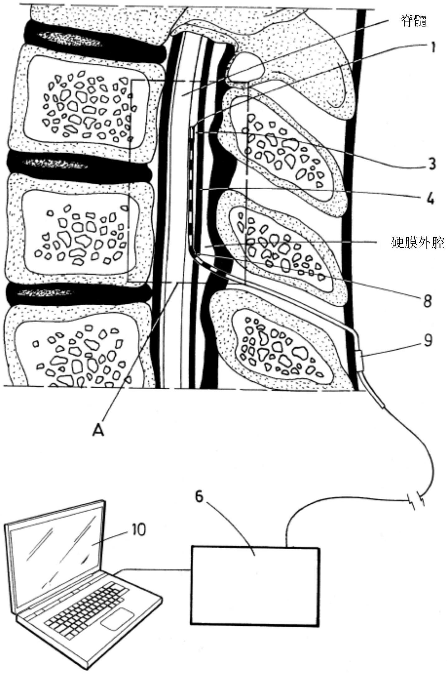 脊髓刺激系统的制作方法