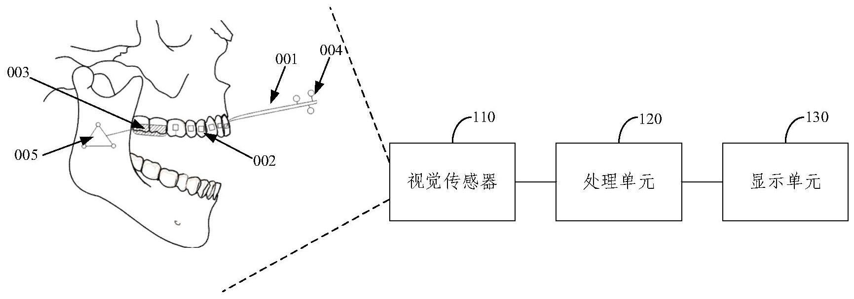 正畸托槽放置系统和方法与流程