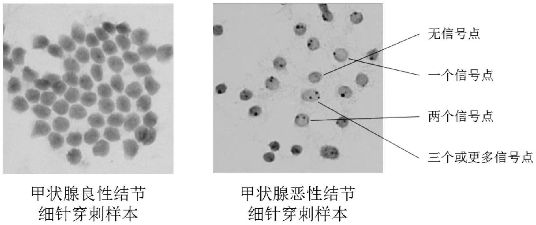 通过超声和印迹基因检测联合鉴别甲状腺结节良恶性方法与流程