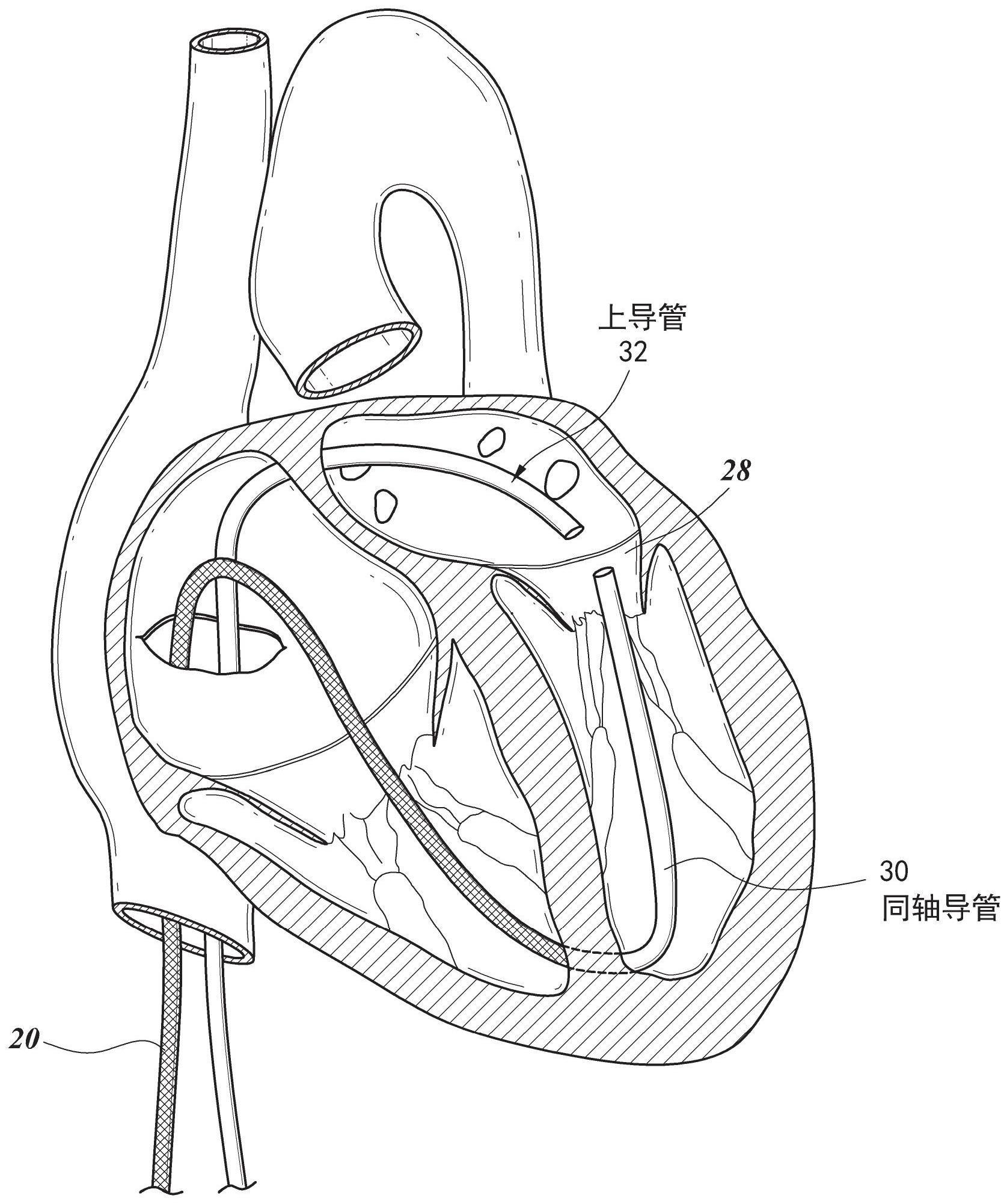 二尖瓣瓣叶拴系的制作方法