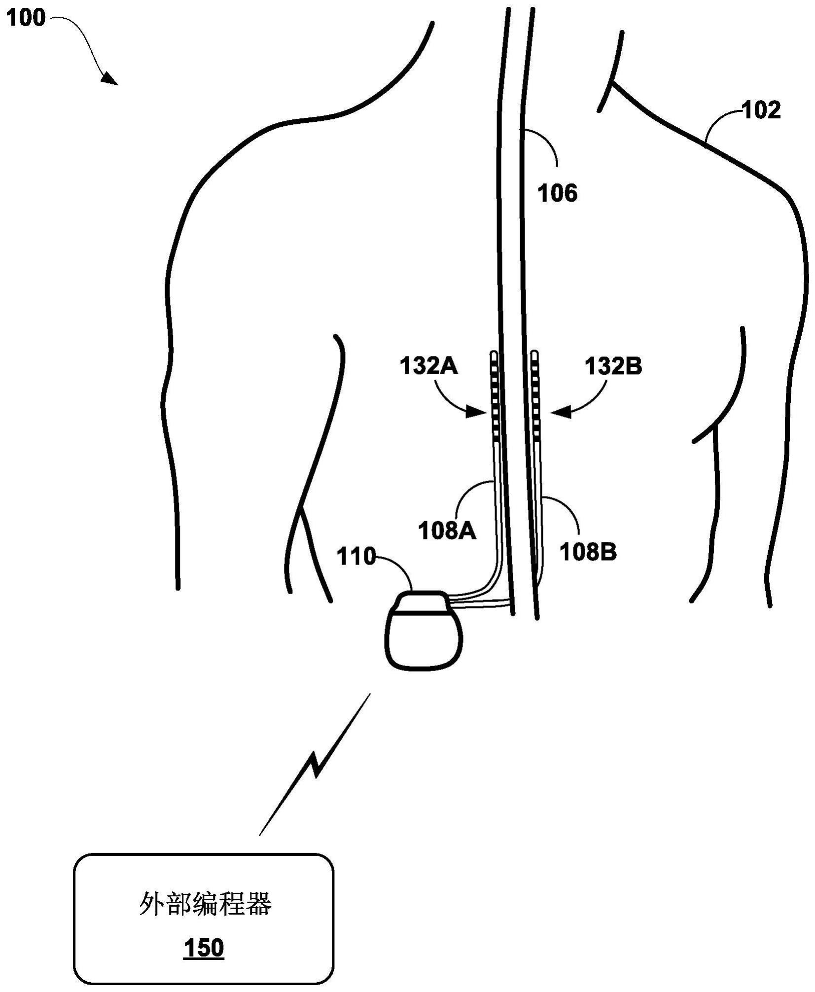 感测诱发复合动作电位（ECAP）的制作方法