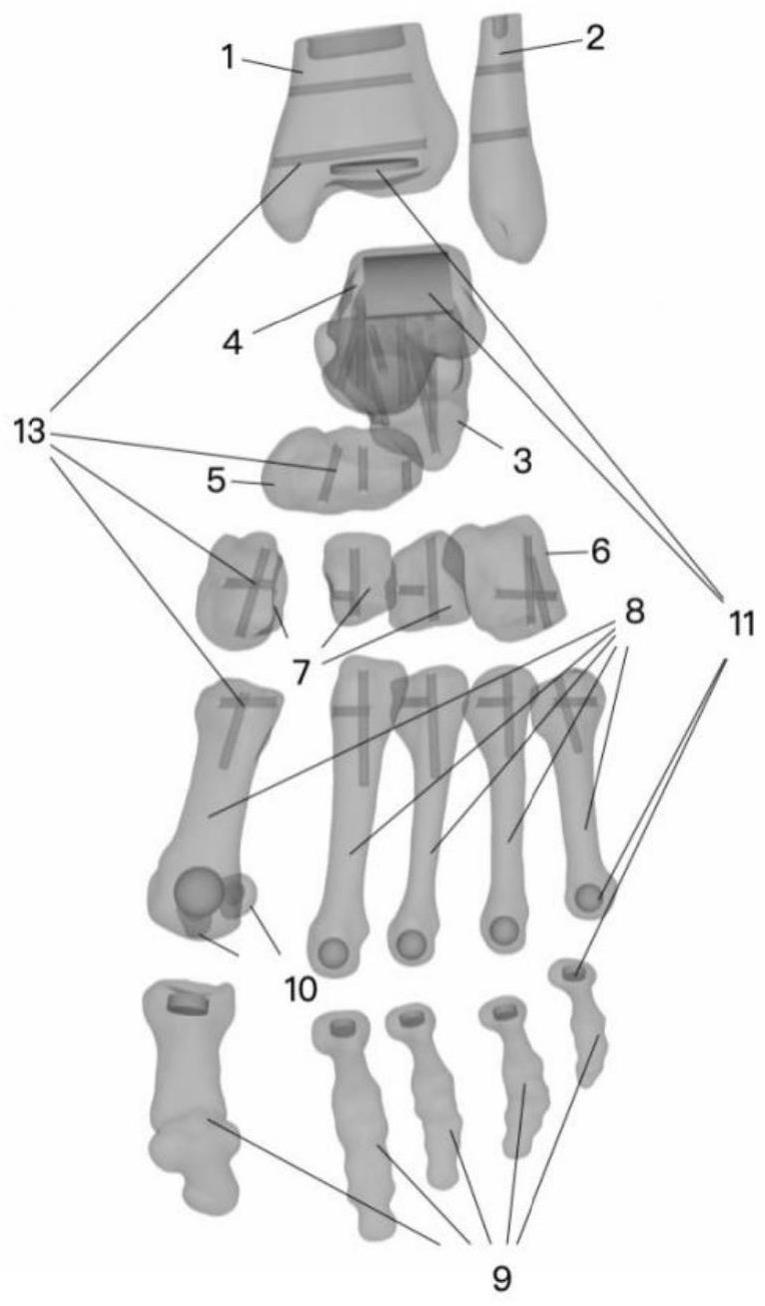 一种可拆卸微创拇外翻截骨训练足部骨骼模型的制作方法