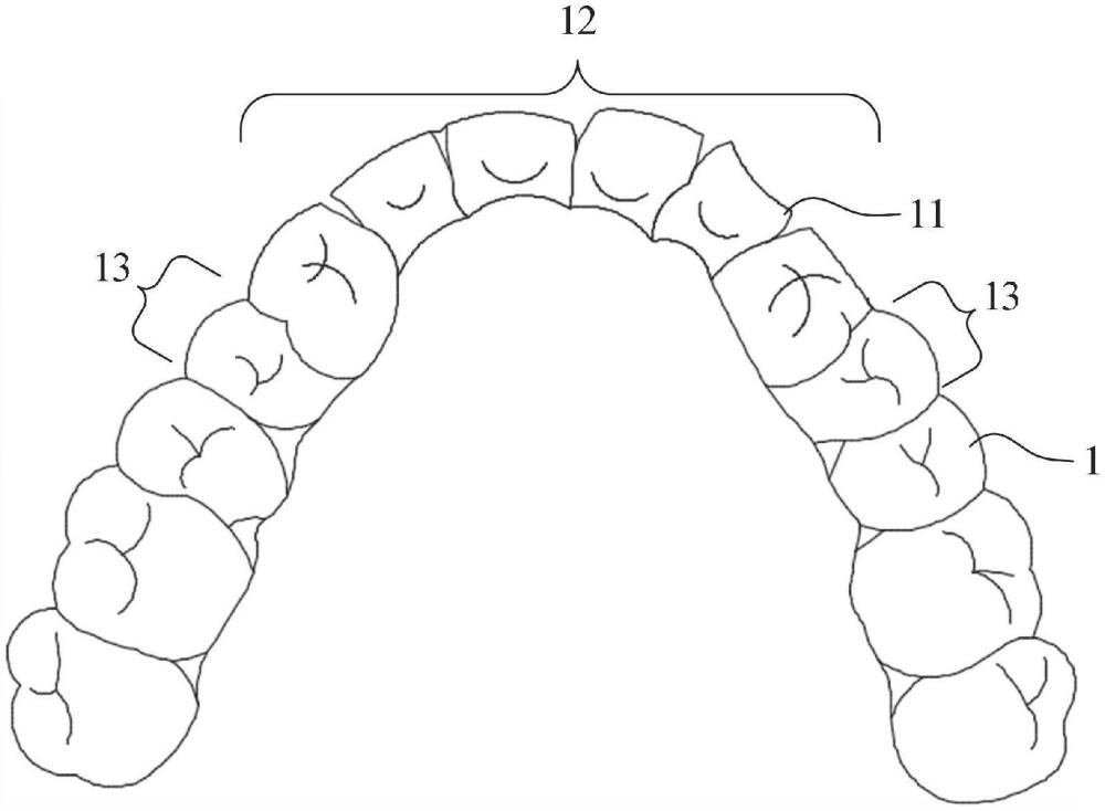 用于牙齿压低的壳状牙科器械的制作方法
