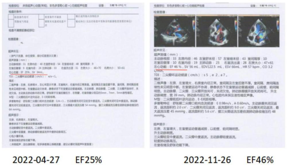 一种治疗急性心肌梗死心肌微循环障碍的中药颗粒及其制备方法