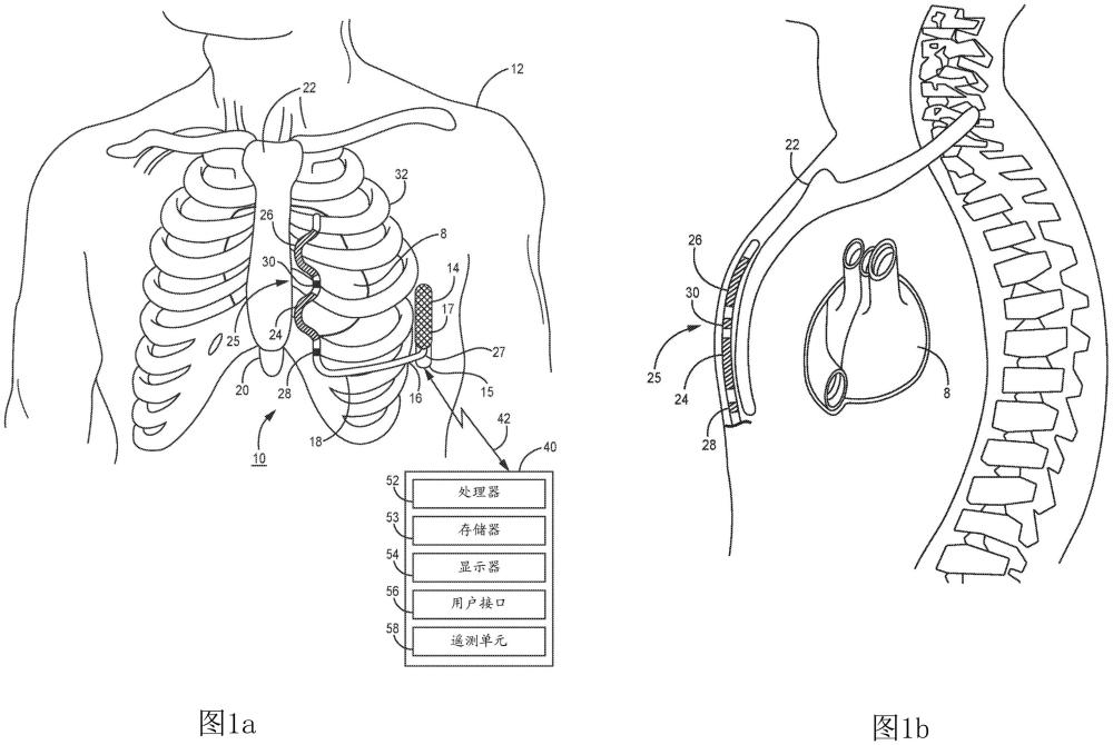用于递送心脏起搏脉冲的医疗装置和方法与流程