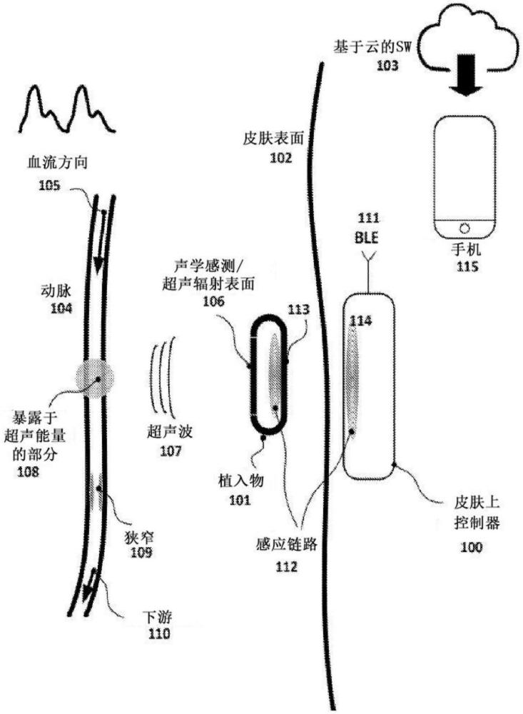 用于影响血管血流的装置及其方法与流程