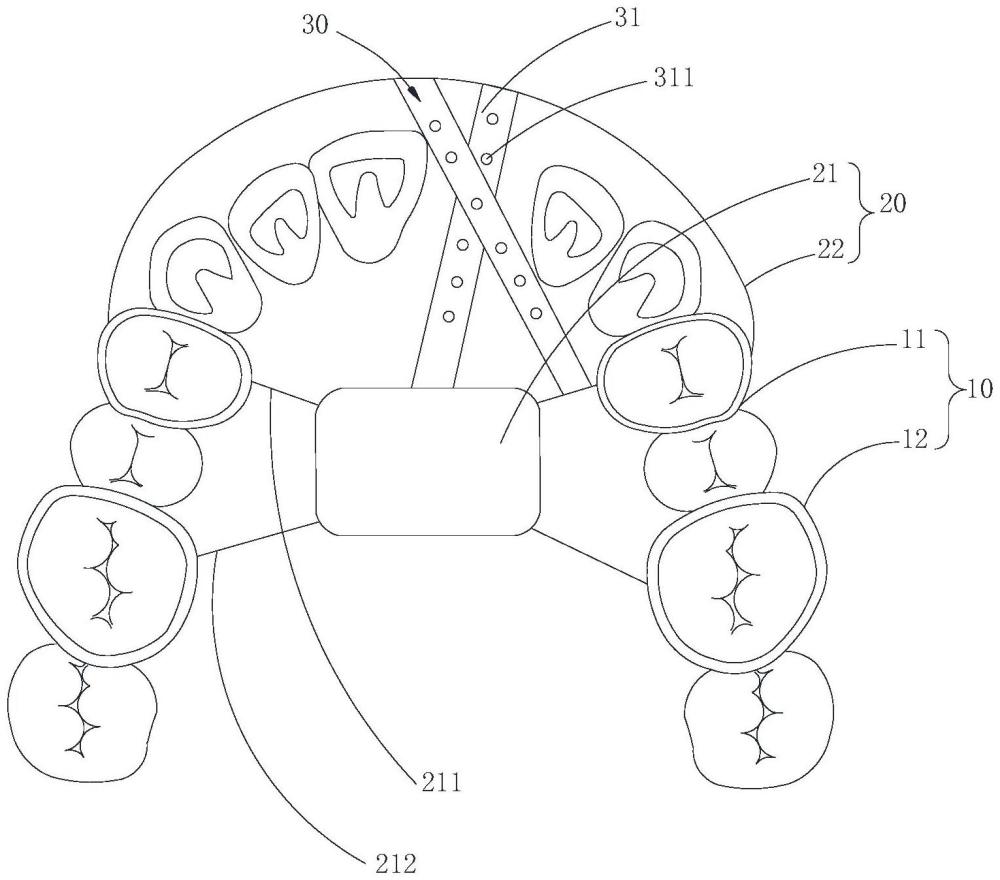 一种上颌埋伏牙的三维牵引装置