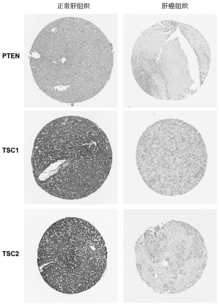 PTEN、TSC1和TSC2基因在马兜铃酸敏感性检测中的应用