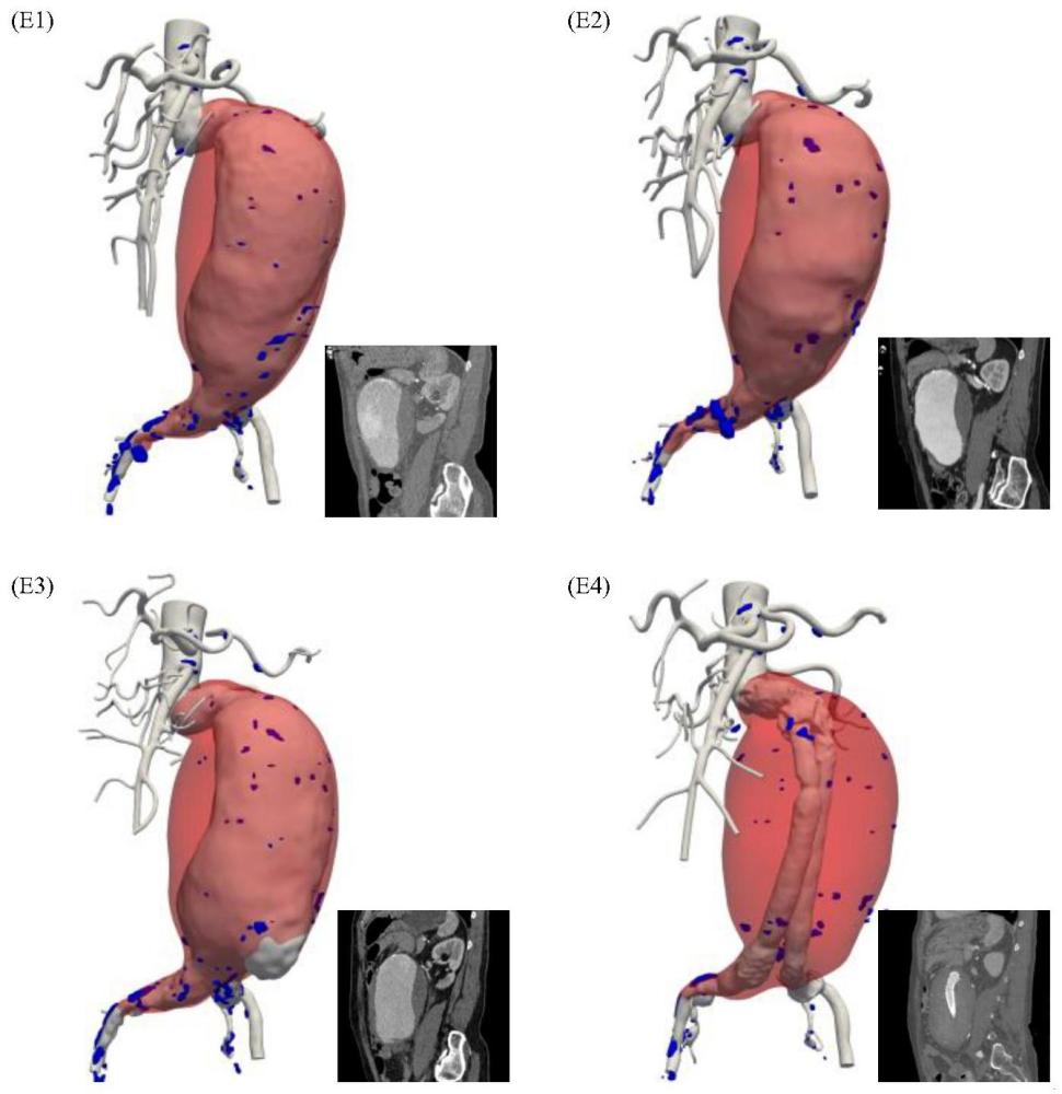 基于血流动力学评估动脉瘤状态变化的方法与流程