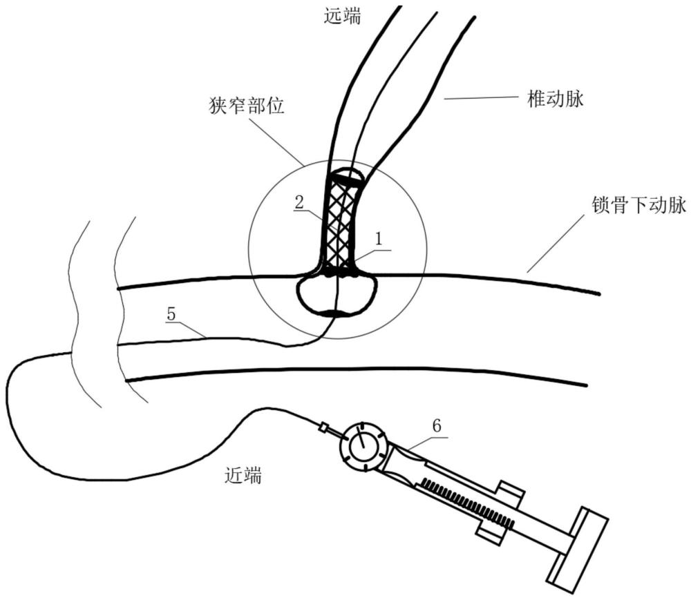 一种精准定位的分阶段球囊扩张椎动脉支架系统及方法与流程