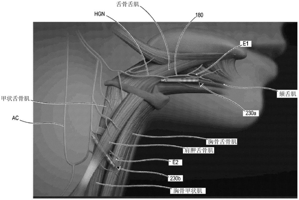 用于放置可植入电极以治疗睡眠呼吸暂停的技术以及相关联的系统的制作方法