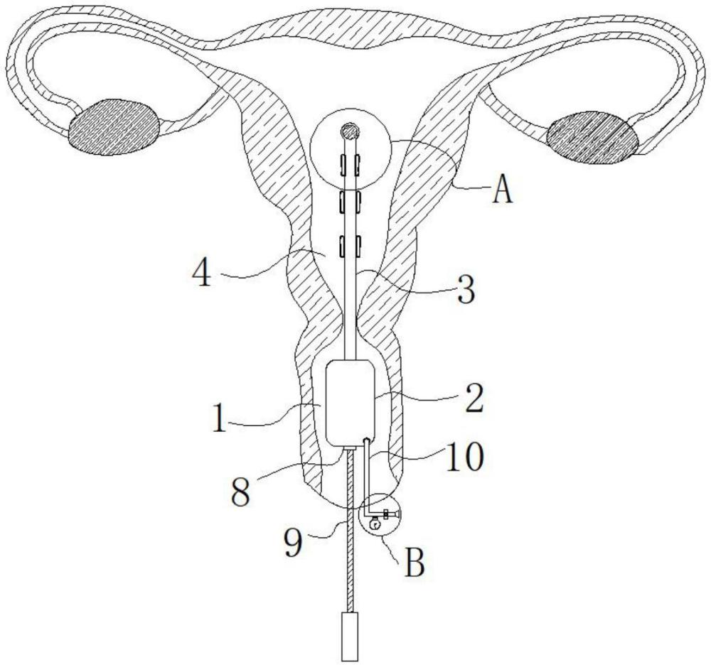 宫腔粘连防治器的制作方法