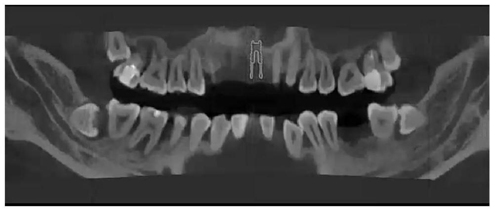 一种将种植体规划映射于口腔全景图的方法及系统与流程