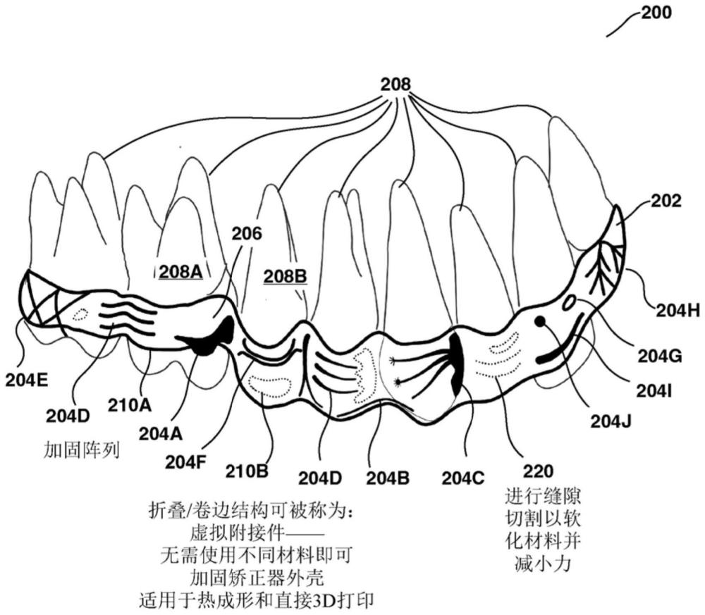 具有分层结构和材料的智能正牙矫治器的制作方法