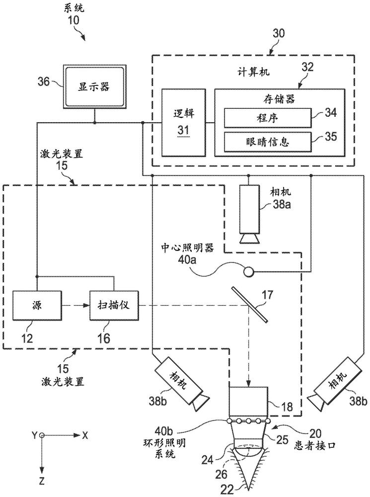 对接眼睛以进行眼科激光治疗的制作方法