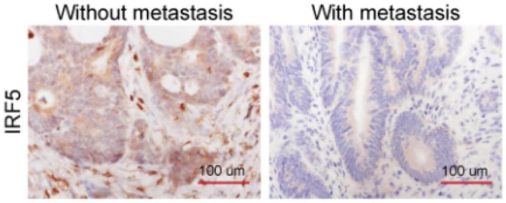 IRF5在結直腸癌轉移中的應用的制作方法