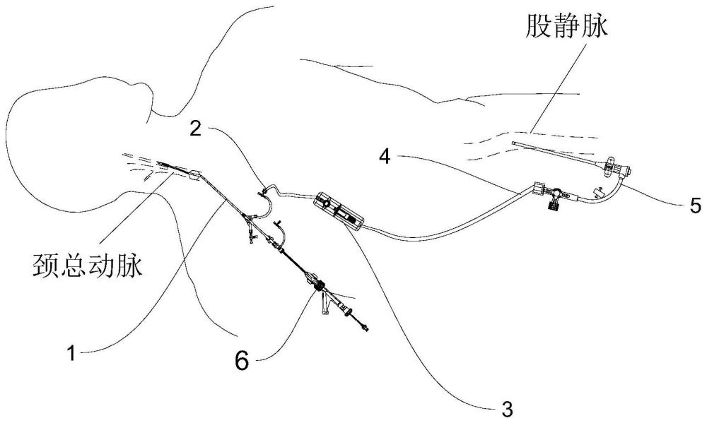 一種血流重建系統(tǒng)的制作方法