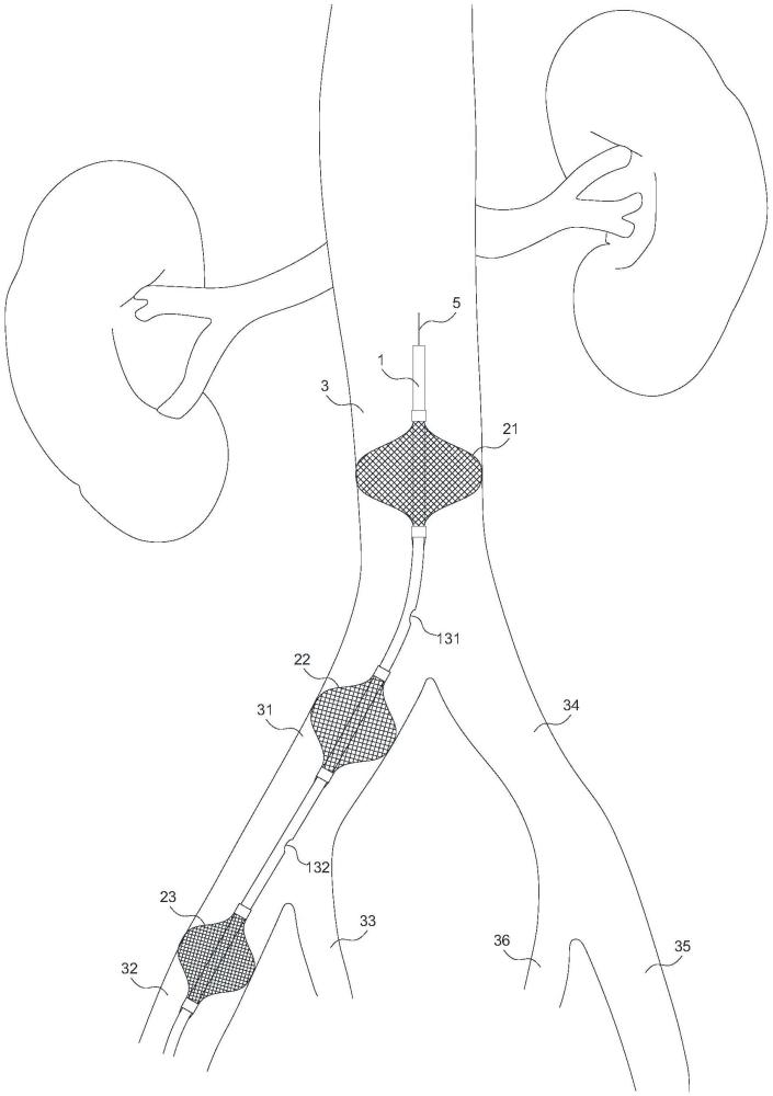 一種密網(wǎng)式血管腔內(nèi)介入止血系統(tǒng)