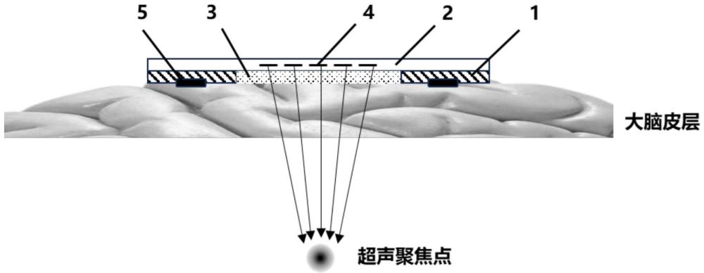 一種腦電-超聲復合ECoG電極的制作方法