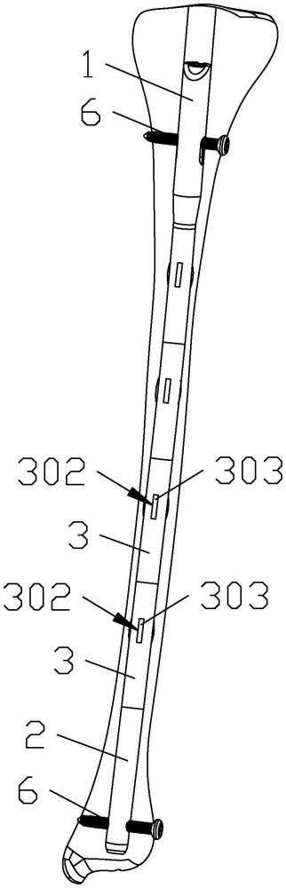 一種穩(wěn)定的多功能髓內(nèi)釘系統(tǒng)的制作方法