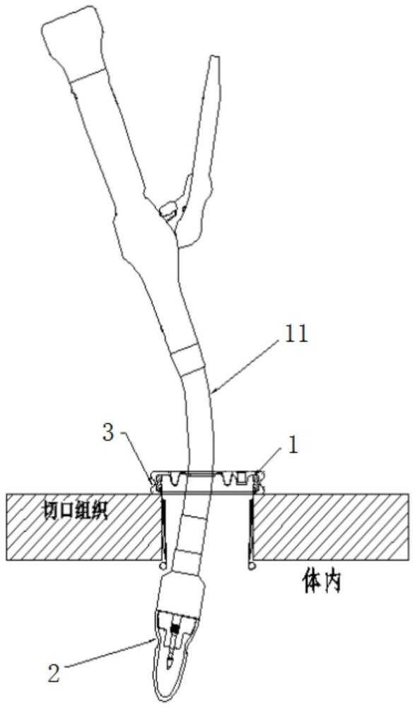 管型吻合器導引保護套組件